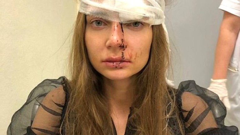 Dudaklarına silikon yaptırmak isteyen Rus şarkıcı, doktorunun saldırısına uğradı!